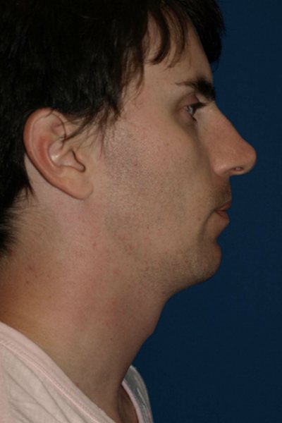 Rhinoplasty Before & After Image