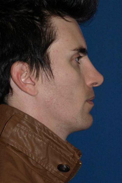 Rhinoplasty Before & After Image