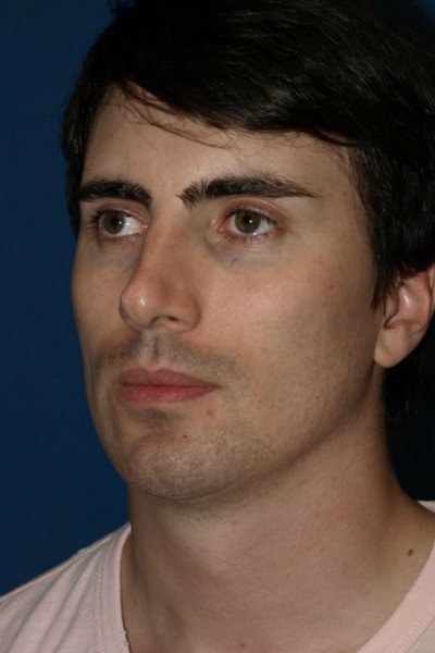 Rhinoplasty Before & After Image