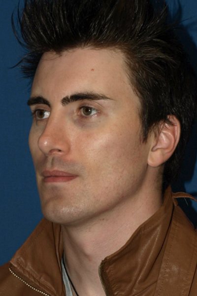 Rhinoplasty Before & After Image