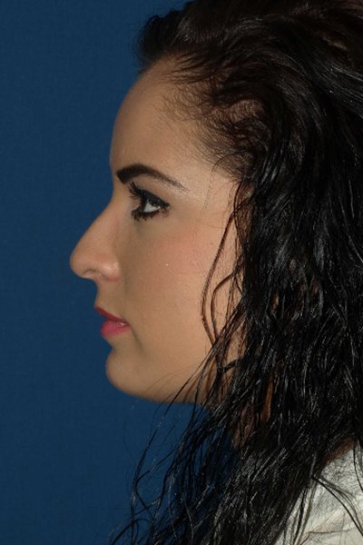 Rhinoplasty Before & After Image