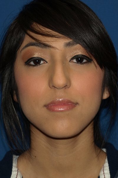 Rhinoplasty Before & After Image