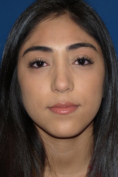 Rhinoplasty Before & After Image