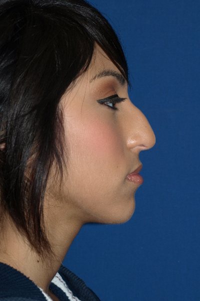 Rhinoplasty Before & After Image