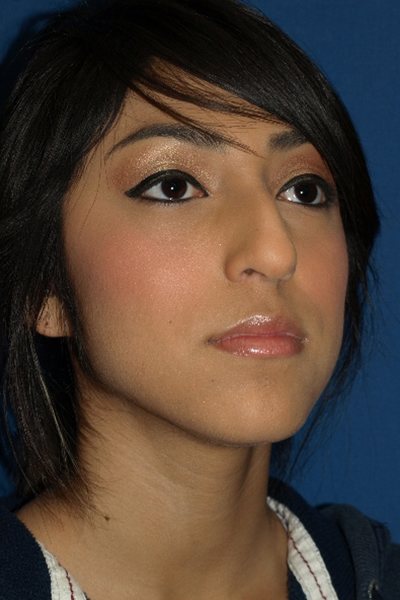 Rhinoplasty Before & After Image