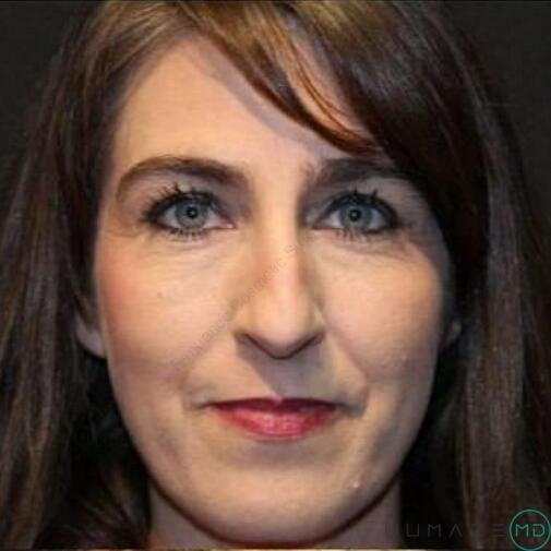 Rhinoplasty Before & After Image