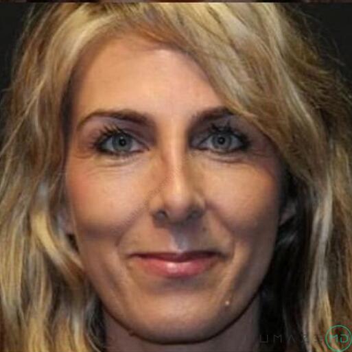 Rhinoplasty Before & After Image