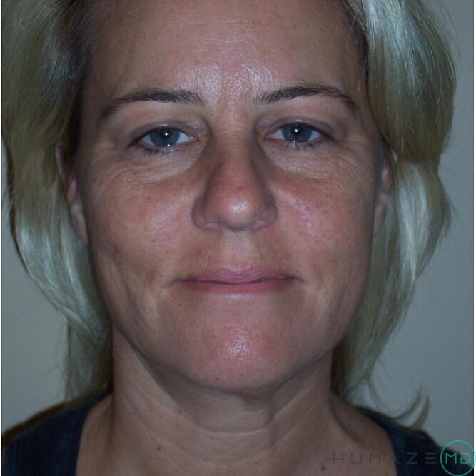 Chemical Peels Before & After Image