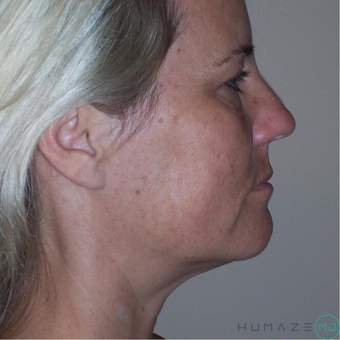 Chemical Peels Before & After Image