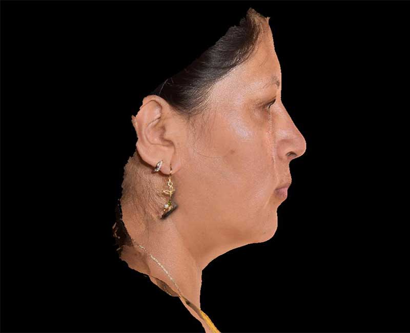 Evoke Before & After Image