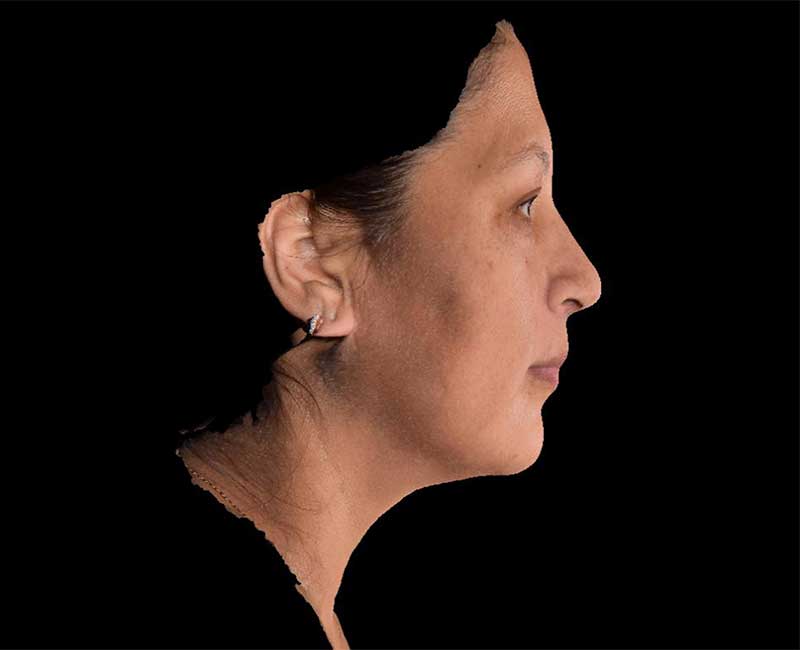 Evoke Before & After Image