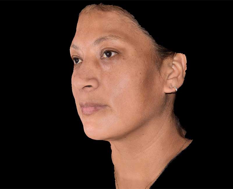 Evoke Before & After Image