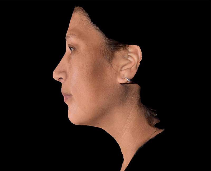 Evoke Before & After Image