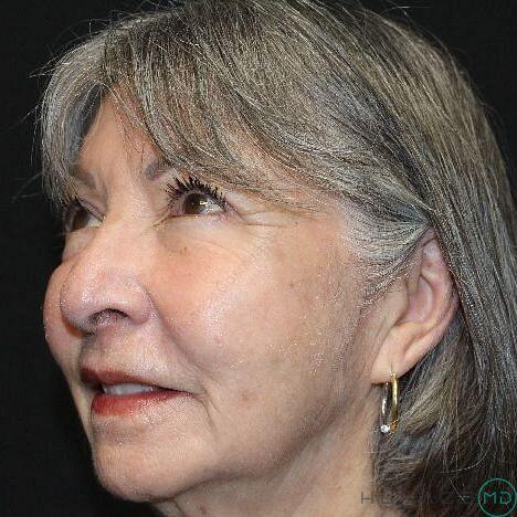 Laser Treatments Before & After Image