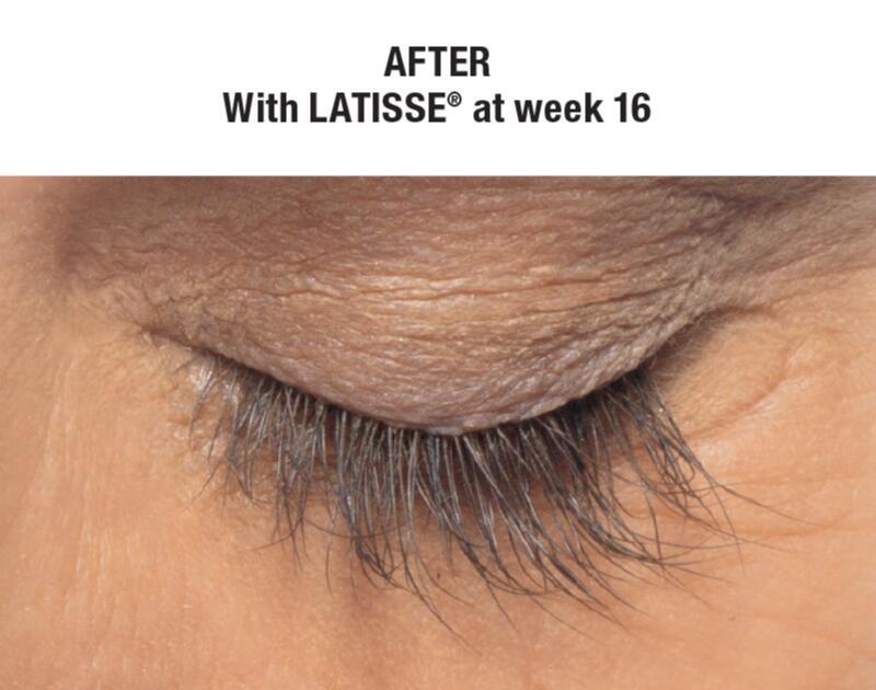 LATISSE Before & After Image