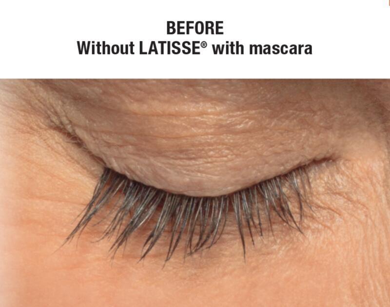 LATISSE Before & After Image