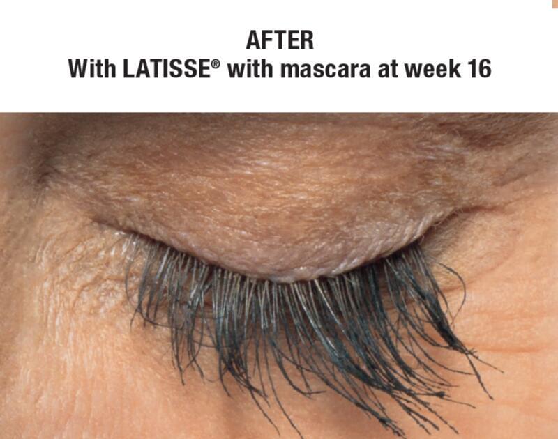 LATISSE Before & After Image