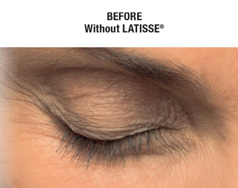 LATISSE Before & After Image