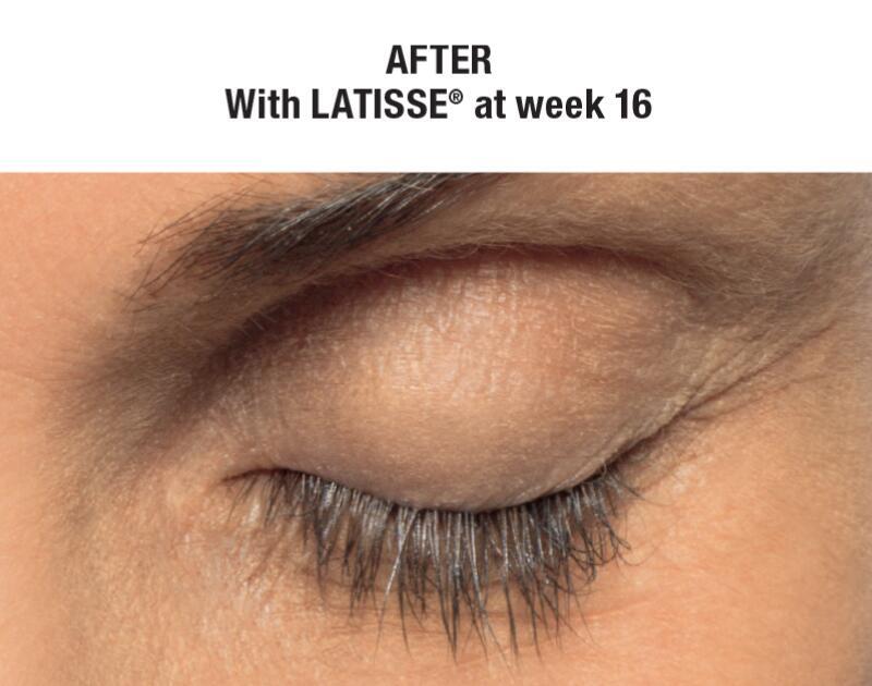 LATISSE Before & After Image