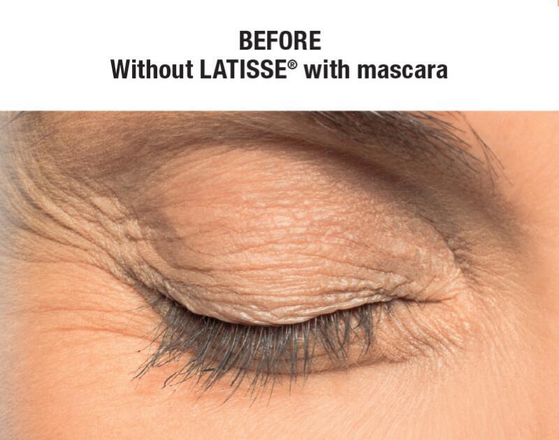 LATISSE Before & After Image