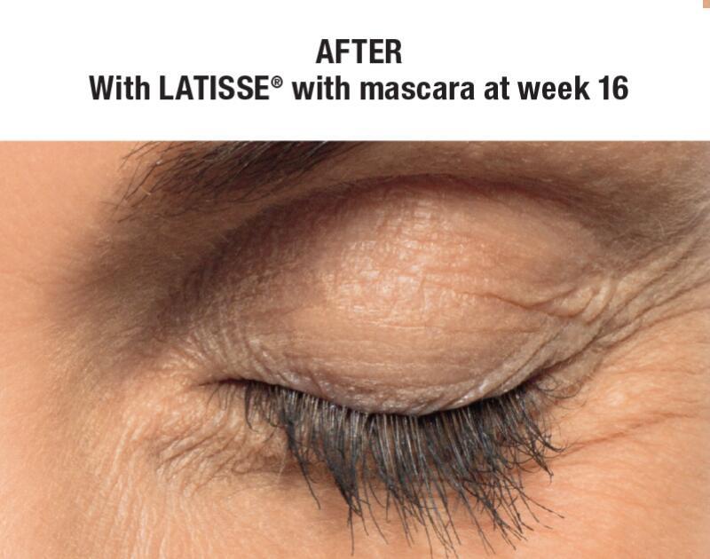 LATISSE Before & After Image