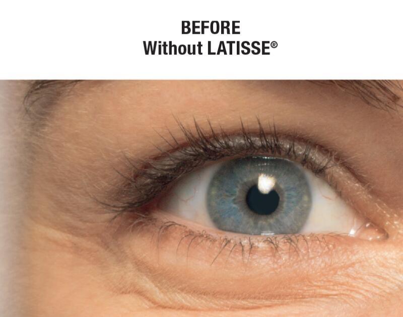 LATISSE Before & After Image