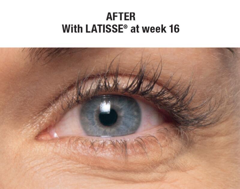 LATISSE Before & After Image