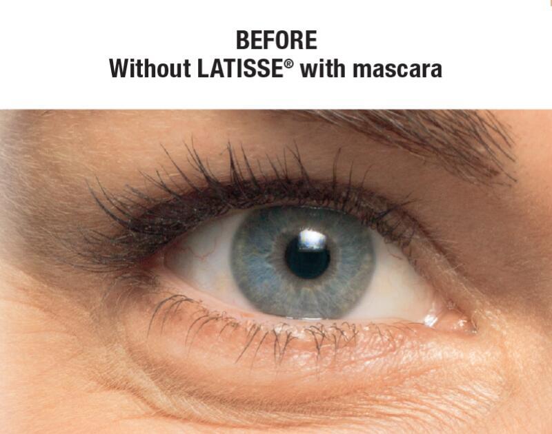 LATISSE Before & After Image
