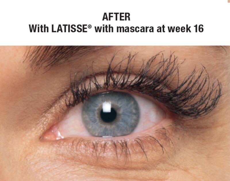 LATISSE Before & After Image