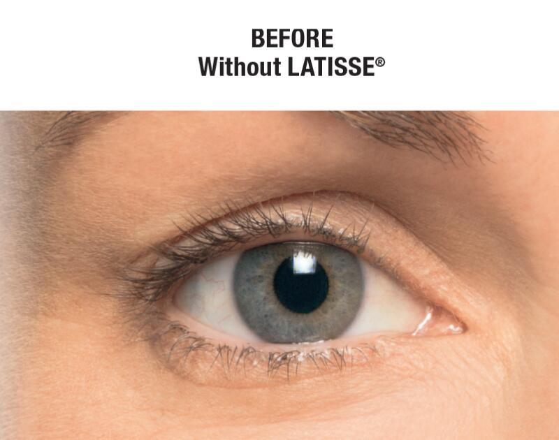 LATISSE Before & After Image