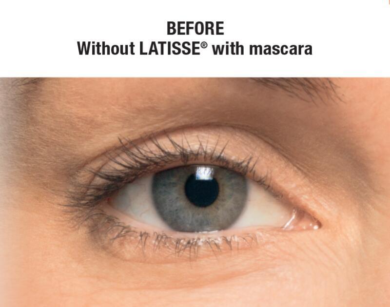 LATISSE Before & After Image