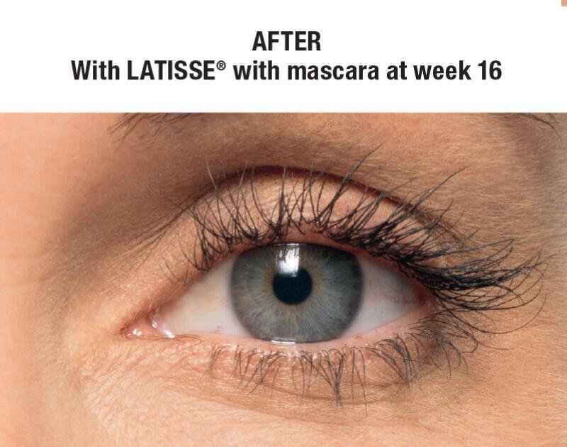 LATISSE Before & After Image