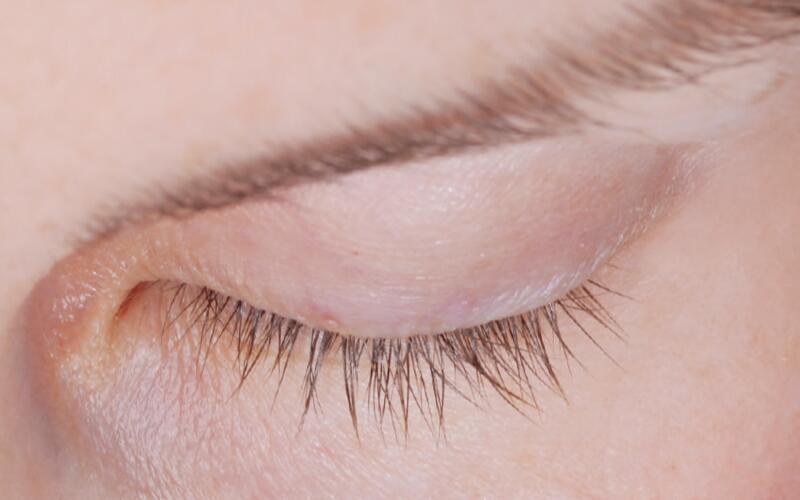 LATISSE Before & After Image