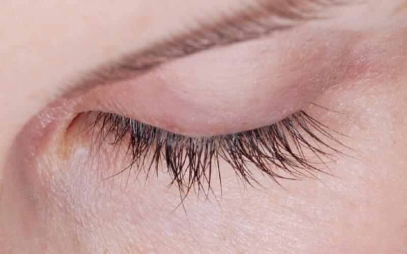 LATISSE Before & After Image