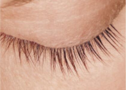 LATISSE Before & After Image