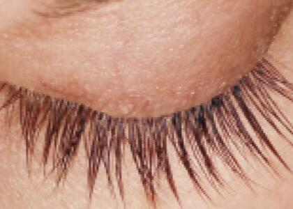 LATISSE Before & After Image