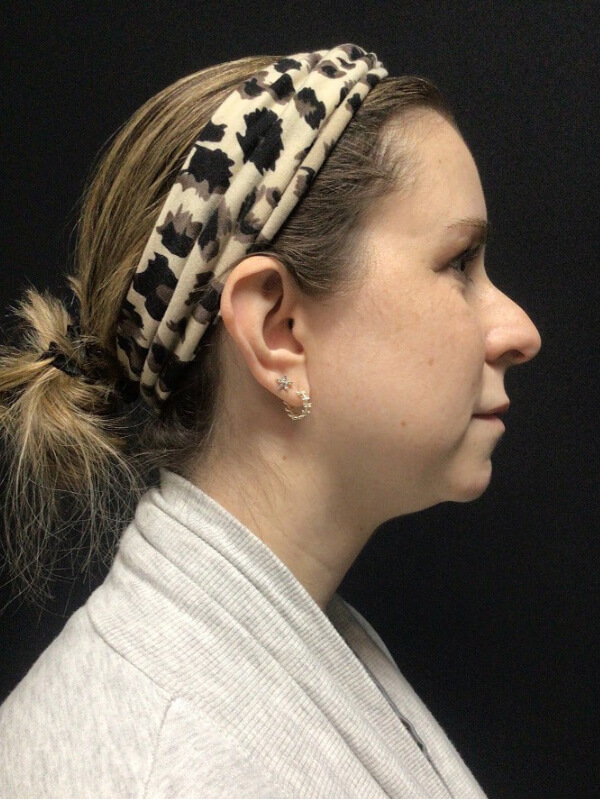 ReNuvion Before & After Image