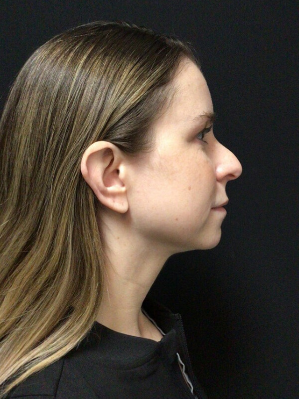 ReNuvion Before & After Image